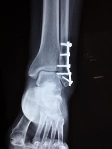 an ancle fracture